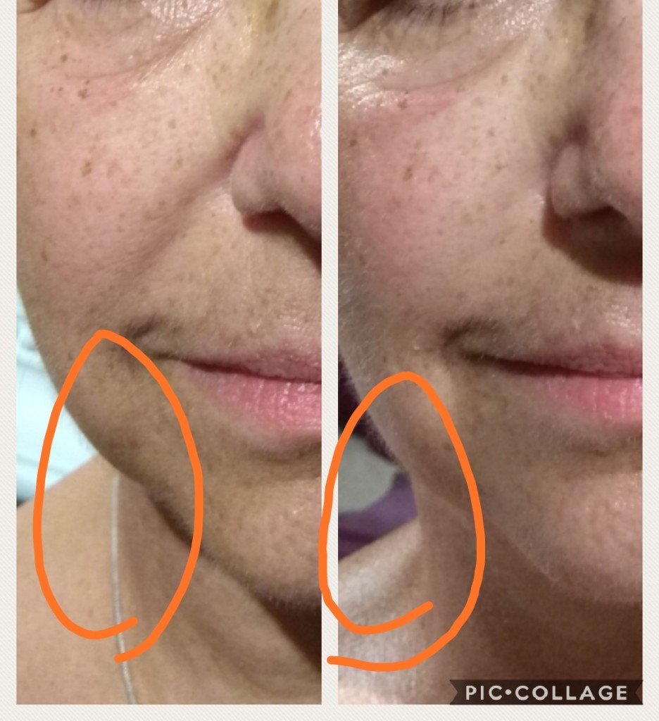 העלמת קמטים ומתיחה של העור