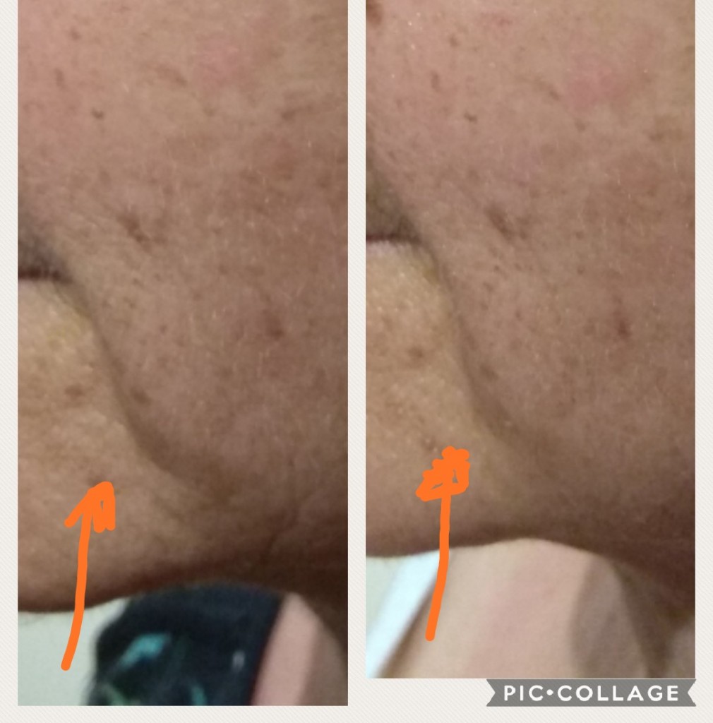 העלמת קמטים ומתיחה של העור