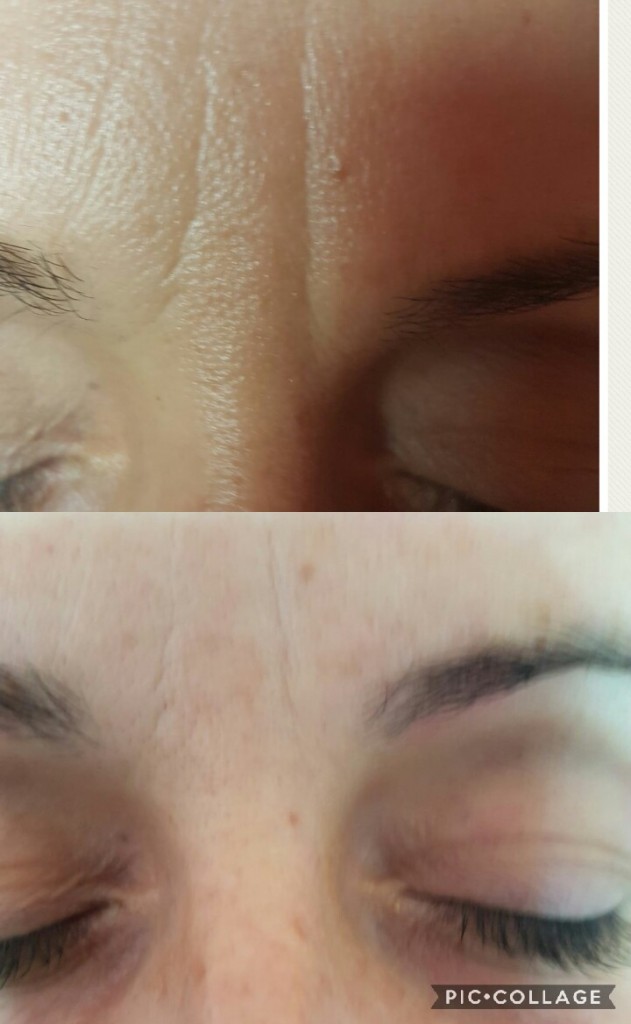 העלמת קמטים