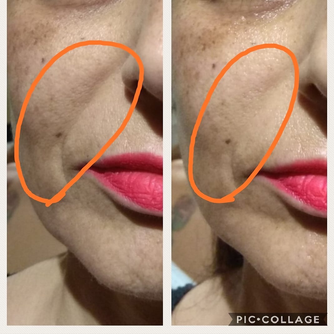 לפני ואחרי טיפול